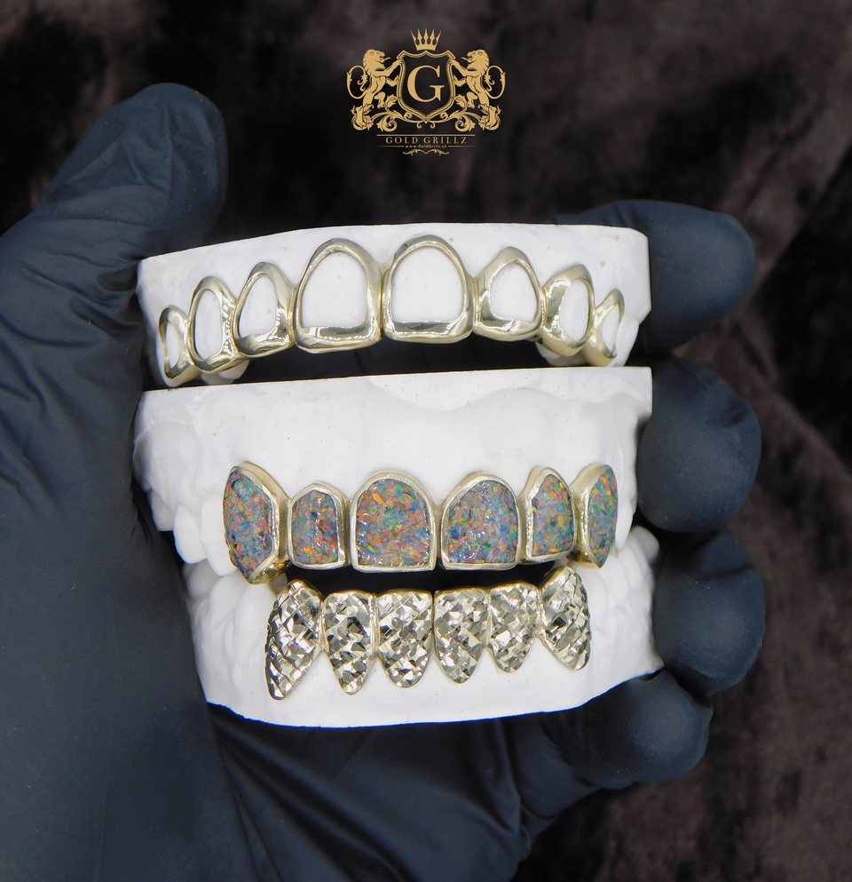 Custom gold grillz and opal grillz displayed on dental models